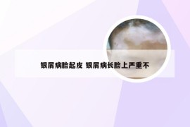银屑病脸起皮 银屑病长脸上严重不