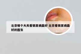 北京哪个大夫看银屑病最好 北京看银屑病最好的医生