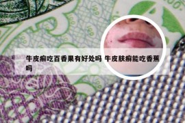牛皮癣吃百香果有好处吗 牛皮肤癣能吃香蕉吗