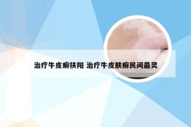治疗牛皮癣扶阳 治疗牛皮肤癣民间最灵