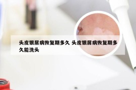 头皮银屑病恢复期多久 头皮银屑病恢复期多久能洗头