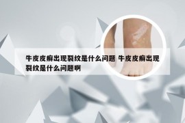 牛皮皮癣出现裂纹是什么问题 牛皮皮癣出现裂纹是什么问题啊