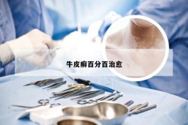 牛皮癣百分百治愈