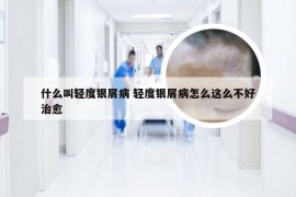 什么叫轻度银屑病 轻度银屑病怎么这么不好治愈