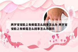 两岁宝宝脸上有癣是怎么回事怎么办 两岁宝宝脸上有癣是怎么回事怎么办图片
