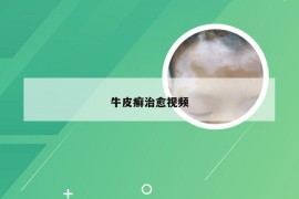 牛皮癣治愈视频