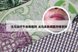 义乌治疗牛皮癣医院 义乌皮肤病医院哪家好