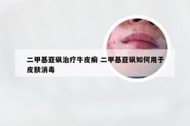 二甲基亚砜治疗牛皮癣 二甲基亚砜如何用于皮肤消毒