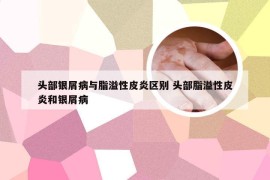 头部银屑病与脂溢性皮炎区别 头部脂溢性皮炎和银屑病