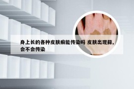 身上长的各种皮肤癣能传染吗 皮肤出现藓,会不会传染