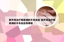 紫外线治疗银屑病的不良反应 紫外线治疗银屑病的不良反应有哪些