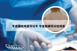 牛皮癣吃鸡蛋可以不 牛皮肤癣可以吃鸡蛋