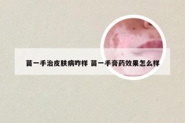 苗一手治皮肤病咋样 苗一手膏药效果怎么样