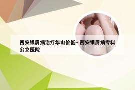 西安银屑病治疗华山价低~ 西安银屑病专科公立医院