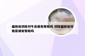 扁桃体切除对牛皮癣有帮助吗 切除扁桃体对银屑病有帮助吗