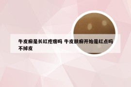 牛皮癣是长红疙瘩吗 牛皮肤癣开始是红点吗不掉皮