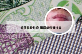 银屑性脊柱炎 银屑病性脊柱炎