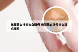 无花果白汁能治白斑吗 无花果白汁能治白斑吗图片