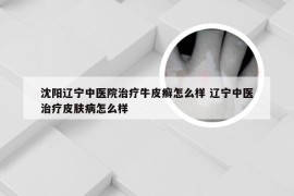 沈阳辽宁中医院治疗牛皮癣怎么样 辽宁中医治疗皮肤病怎么样