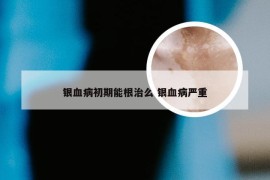 银血病初期能根治么 银血病严重