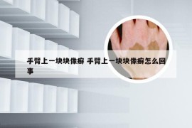 手臂上一块块像癣 手臂上一块块像癣怎么回事