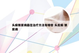 头癣银屑病最佳治疗方法有哪些 头皮癣 银屑病
