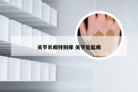 关节长癣特别痒 关节处起癣