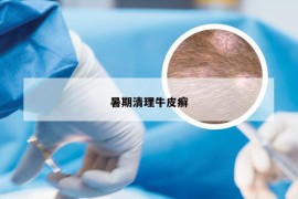 暑期清理牛皮癣