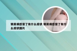 银屑病感冒了有什么症状 银屑病感冒了有什么症状图片
