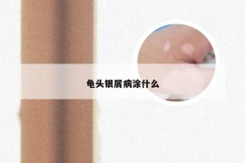 龟头银屑病涂什么