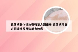 银屑病氧化锌软膏和复方酮康唑 银屑病用复方酮康唑发用洗剂有效吗