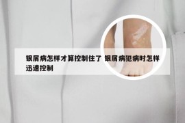 银屑病怎样才算控制住了 银屑病犯病时怎样迅速控制