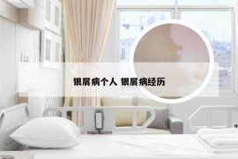 银屑病个人 银屑病经历