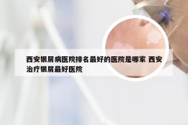 西安银屑病医院排名最好的医院是哪家 西安治疗银屑最好医院