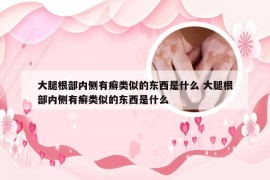 大腿根部内侧有癣类似的东西是什么 大腿根部内侧有癣类似的东西是什么