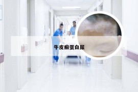 牛皮癣蛋白尿