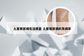 儿童银屑病生活质量 儿童银屑病的发病率