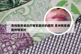 贵阳银屑病治疗哪家最好的医院 贵州银屑病医院哪家好