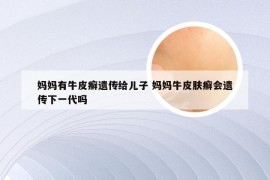 妈妈有牛皮癣遗传给儿子 妈妈牛皮肤癣会遗传下一代吗