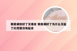 银屑病快好了又爆皮 银屑病好了为什么又起了红疙瘩没有起皮