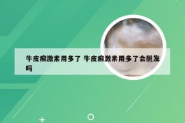 牛皮癣激素用多了 牛皮癣激素用多了会脱发吗