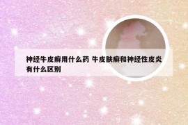 神经牛皮癣用什么药 牛皮肤癣和神经性皮炎有什么区别