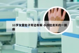 11岁女童肚子旁边有癣 小孩肚皮长的一圈癣