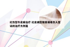 红热型牛皮癣治疗 红皮病型银屑病毒热入营证的治疗方剂是