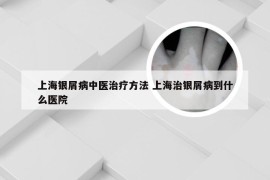 上海银屑病中医治疗方法 上海治银屑病到什么医院