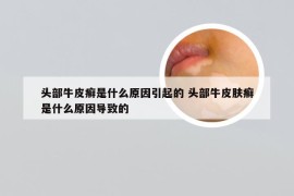 头部牛皮癣是什么原因引起的 头部牛皮肤癣是什么原因导致的