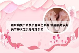 银屑病关节炎关节肿大怎么办 银屑病关节炎关节肿大怎么办吃什么药