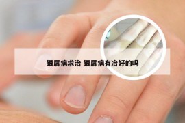 银屑病求治 银屑病有冶好的吗