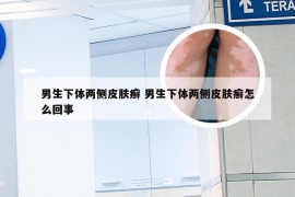 男生下体两侧皮肤癣 男生下体两侧皮肤癣怎么回事