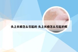 头上长癣怎么引起的 头上长癣怎么引起的呢